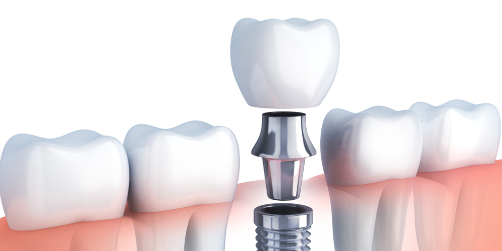 FEATURE06 歯周組織の健康を重視したインプラント治療