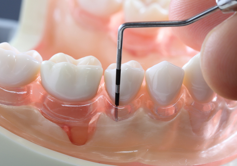 歯周病専門医による専門的な歯周病治療