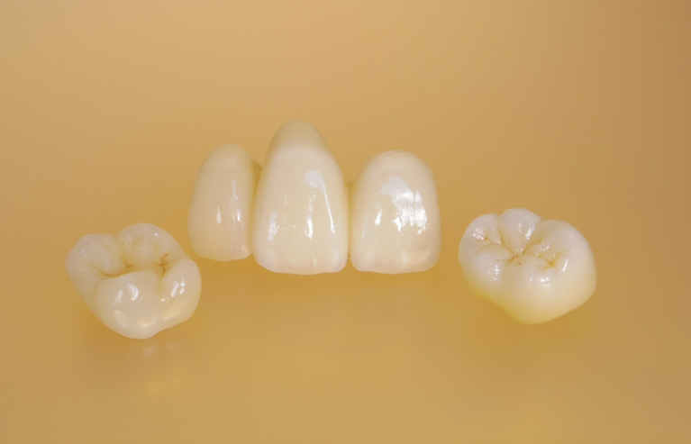 ジルコニア・セラミックなど豊富な選択肢をご案内