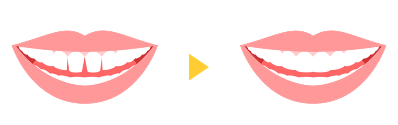 ダイレクトボンディングとは