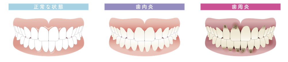 歯肉炎・歯周炎は何が違う？